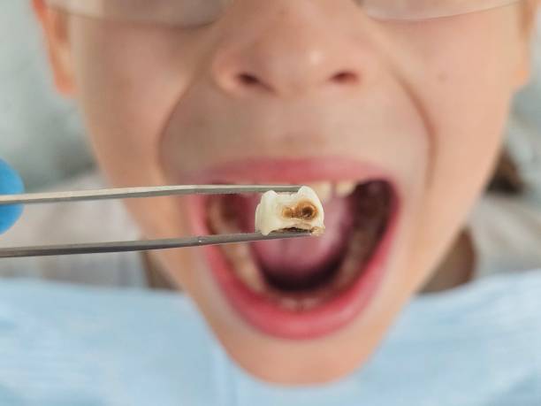 Best Emergency Dentist for Knocked-Out Tooth in Keaau, HI